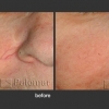 Palomar: Vascular Lesions and Rosacea